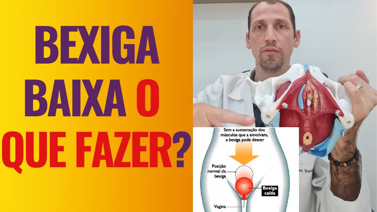 👉Bexiga baixa o que fazer☝