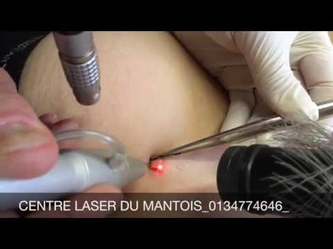 comment soigner nodule visage