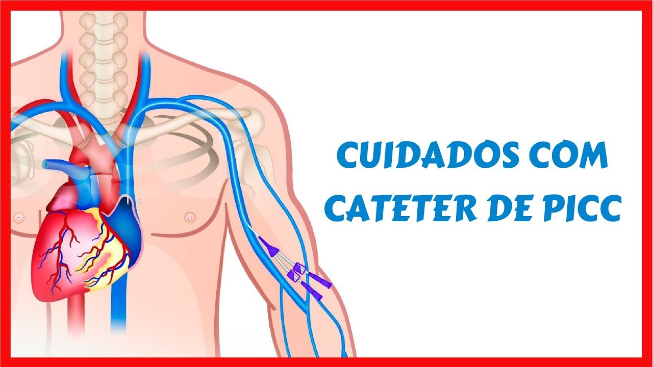 Cuidados de enfermagem com cateter de PICC