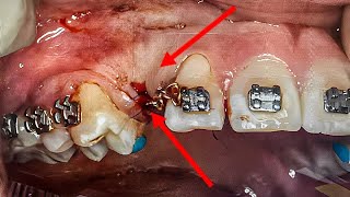 Impacted Canines and Braces...WAIT!