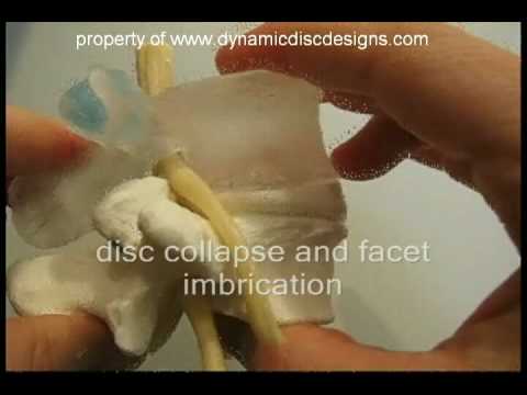 Simulated vertebral endplate fracture by Dynamic Disc Designs