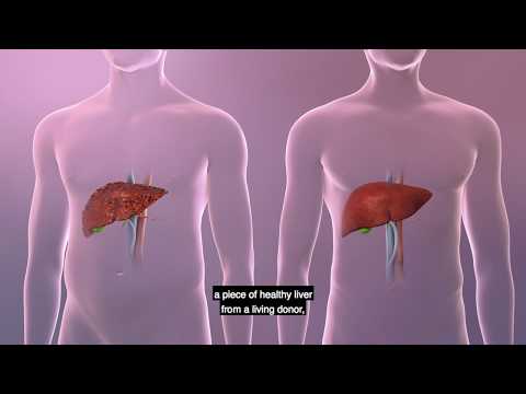 UPMC Living-Donor Liver Transplant