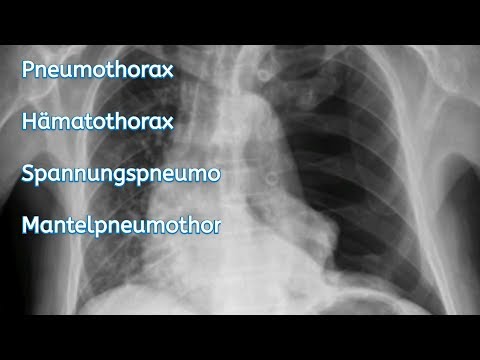 Pneumothorax, hemothorax, tension pneumothorax, mantle pneumothorax.