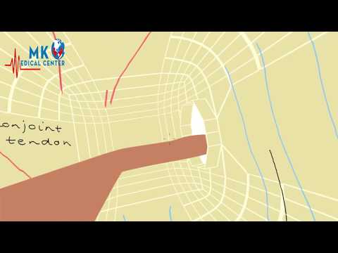 Inguinal hernia anatomy  animation