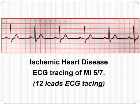 ECG Ischemic Heart Disease:Evaluating 12 leads tracing with MI 5 7