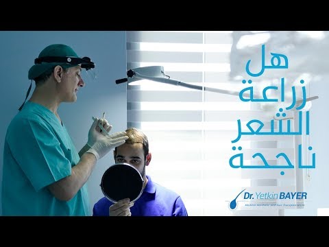 هل عملية زراعة الشعر ناجحة - دكتور يتكين باير - Dr Yetkin Bayer -