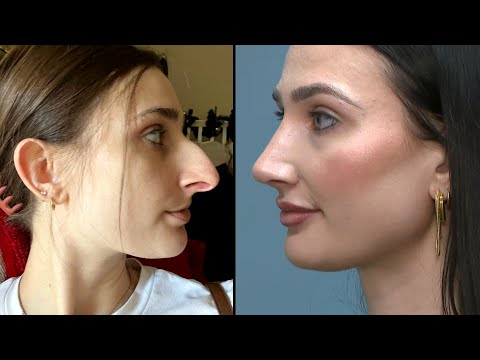 Woman Says She Saved $11,000 Over 10 Years for Nose Job