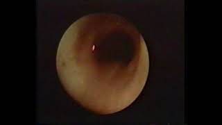Vascular Rings