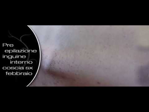 Skintona con lentiggini Il pigmentary nota da posti del corpo