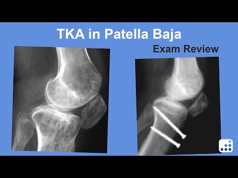 TKA in Patella Baja Exam Review - Ron Delanois, MD