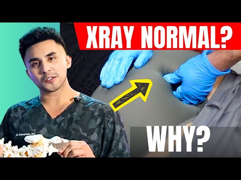 Tailbone *COCCYX* Pain Explained   Causes, Symptoms, & Best Treatment Options