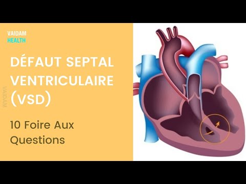 DÉFAUT SEPTAL VENTRICULAIRE (VSD)