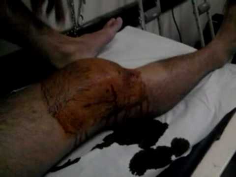 Muscoli della schiena doloranti quando si è stanchi Crema per il collo con osteocondrosi della colonna cervicale