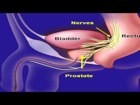 dr krongrad cirugía de prostatitis