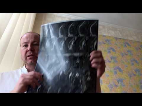 Боль в спине в области лопатки сзади справа Массаж от остеохондроза грудного отдела видео