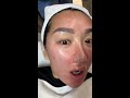 12 LASER SKIN TREATMENTS IN KOREA✨👀