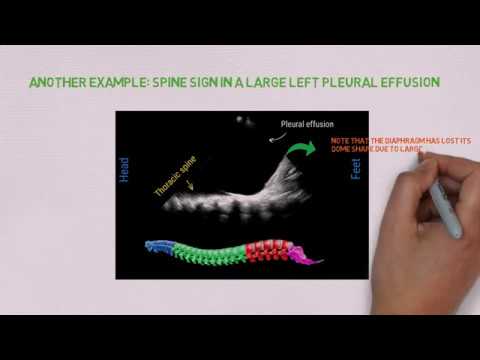 Pleural effusion on ultrasound: the spine sign