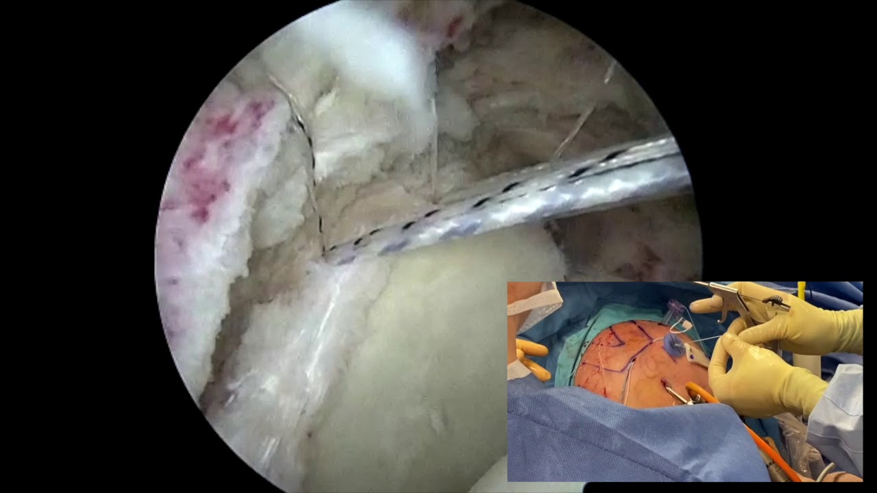 Dr. Garcia demonstrates his Superior Capsular Reconstruction technique.