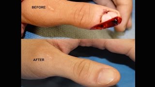 Amazing Thumb Tip Regeneration! IV3000 Wound Dressing for Thumb / Finger Trauma