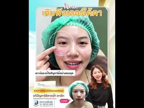 รีวิวหัตถการโปรแกรม Filler ใต้ตา