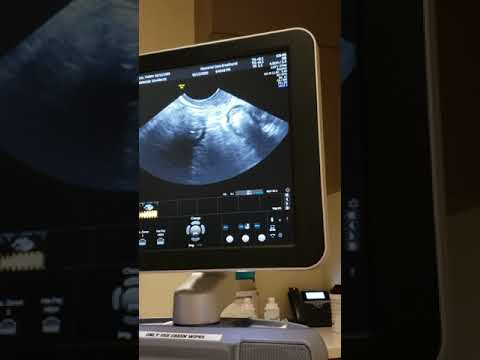 5 weeks 5 days Pregnancy Vaginal Ultrasound | Baby Heartbeat at 108 bpm