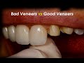 Bad Veneer vs Good Veneer