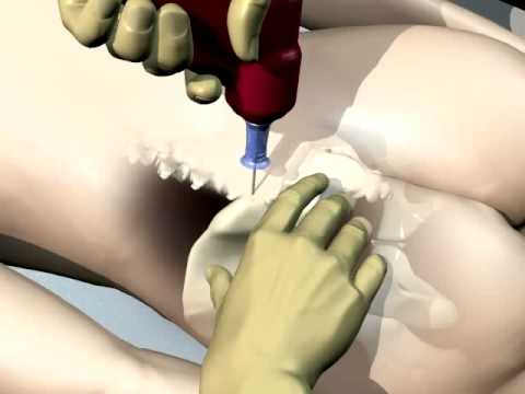 Gelatina in coxartrosi dellanca Contusione del rachide cervicale con tetraparesi