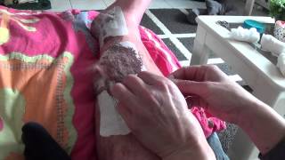 Bandage Removal after Surgery on Leg