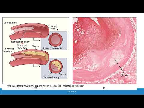 Disorders of Lipid Metabolism