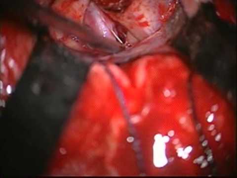Pterional approach for the resection of pituitary macroadenoma