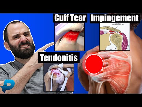 Shoulder Impingement vs Rotator Cuff Tendonitis vs Rotator Cuff Tear l Shoulder Pain