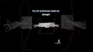Download lagu MRI of the internal auditory canal  and chochlea mp3
