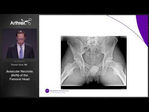 Arthroscopic Treatment of Avascular Necrosis of the Femoral Head