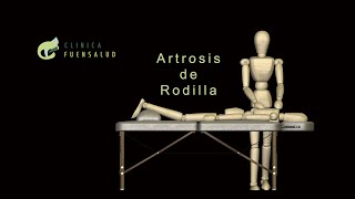 💥 Artrosis de Rodilla 💥