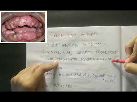 Fibromatosis Gingiva | Development disturbances of Gingiva | Neet MDS