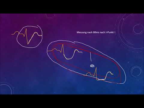 EKG Crashkurs Teil 4: ST-Hebung, ST-Senkung, Hypertrophie