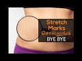 Stretch Mark ஐ நீக்குவது எப்படி Works 100 How To Remove Stretch Mark