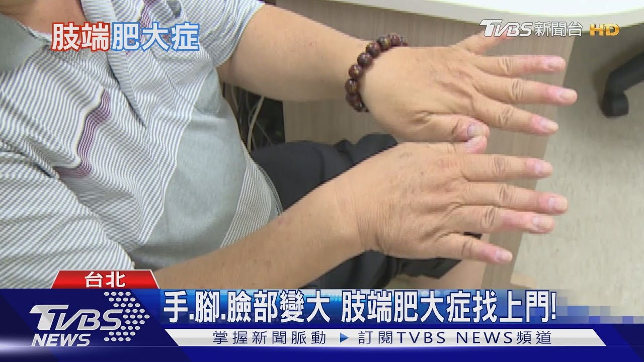 「肢端肥大症」!身體這部位「特徵腫大」 醫警告勿拖延治療