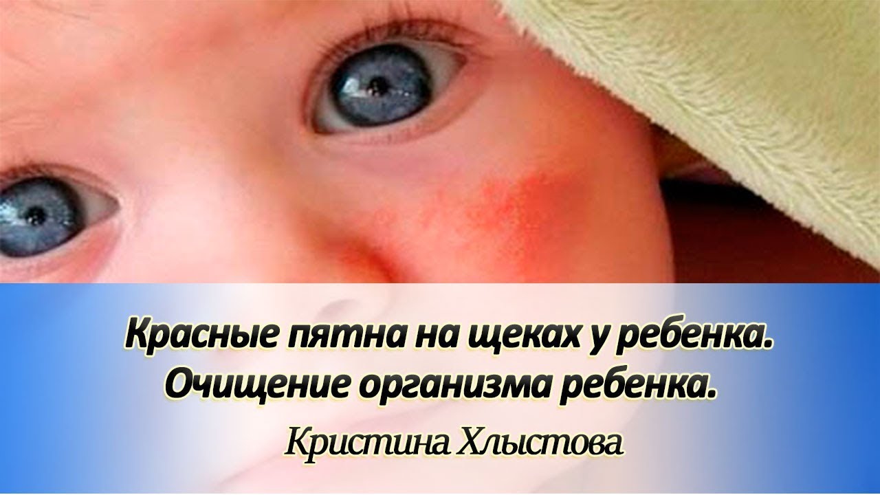 Красные пятна на щеках у ребенка. Очищение организма ребенка | Кристина Хлыстова