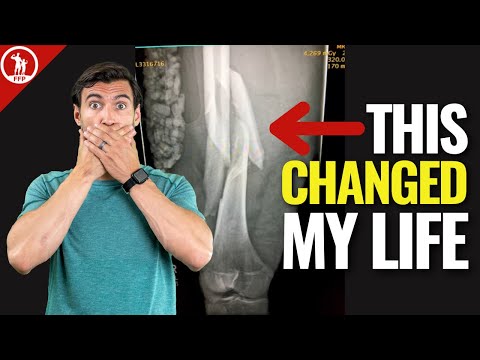 How To Deal With A Major Injury (Dr. A’s Life-Changing Story)