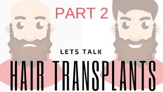 Hair replacement Men's hair system review Lets Talk Transplants TAKE 2