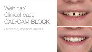 edelweiss CAD/CAM BLOCKs - Webinar & Clinical application with Dr. Stephan Lampl