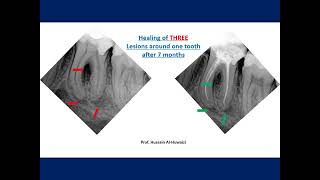 Endodontic Periodontal lesions