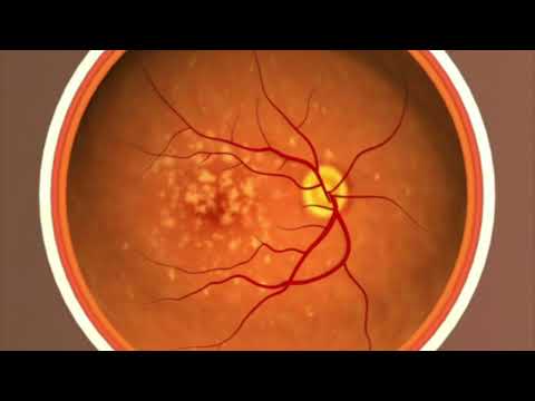 Animación: La degeneración macular relacionada con la edad