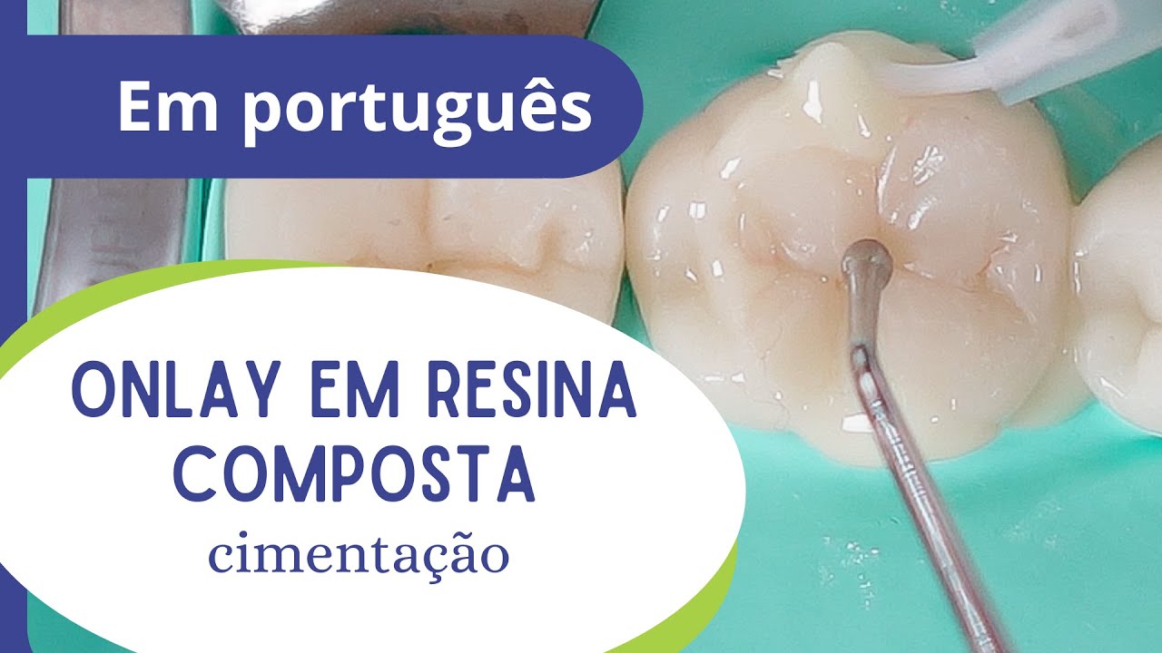 Onlay em resina composta - parte 5 (final): cimentação.