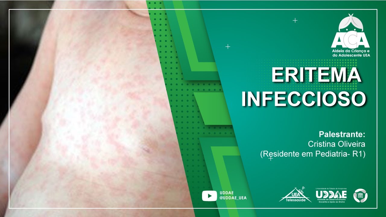 ALDEIA DA CRIANÇA - Eritema infeccioso