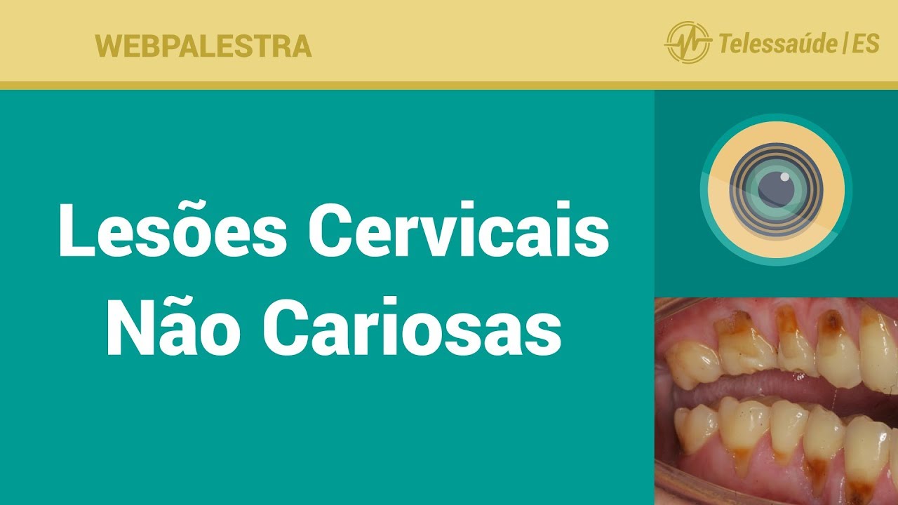 WebPalestra: Lesões Cervicais Não Cariosas