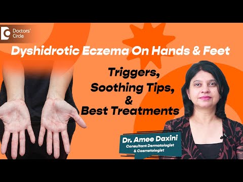 Itchy Hands & Feet | Dyshidrotic Eczema - Triggers & Home Remedies - Dr. Amee Daxini|Doctors' Circle