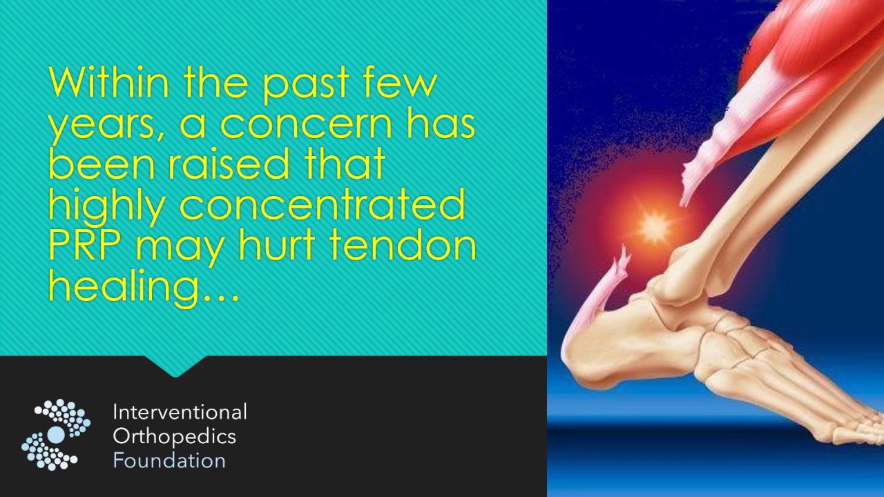 Does Concentrated PRP Hurt or Help Tendon Healing? Regenexx®