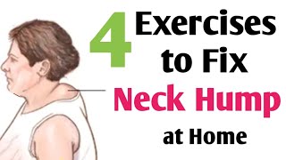 Neck Hump exercises at home | Buffalo Hump | Dowager